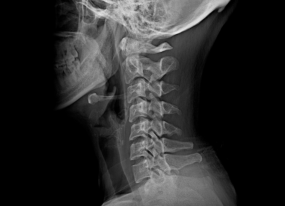 Rayos X cervicales